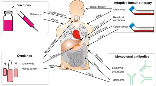 Figure 1. Immune toxicity associated with immunotherapy of cancer. Therapeutic strategies, including vaccines, adoptive immunotherapy, cytokines, and antibodies, can induce immunity against tumor antigens. However, these immune responses can also cause damage to a variety of organ systems as shown.