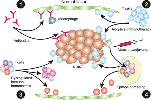 Figure 2. Mechanisms of immune toxicity associated with immunotherapy. (1) The delivery of exogenous antibody specific for TAA expressed on both tumor and normal tissue can result in damage to normal tissue mediated by complement or ADCC mediated by innate immune cells, such as macrophages. (2) Similarly, transfer of TAA-specific T cells can lead to destruction of normal tissue if the TAA is also expressed on cells of normal tissue. (3) Alternate ways of inducing immune reactivity toward normal tissue include dysregulation of normal immune homeostasis using anti–CTLA-4, resulting in expansion of self-reactive T cells. (4) It is also possible that induction of immunity to tumor cells could lead to epitope spreading whereby T cells reactive with self-antigens are generated.