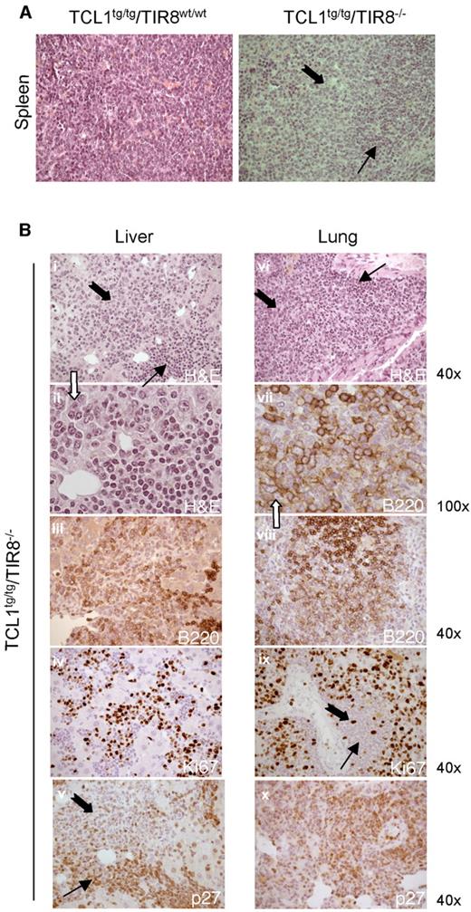 Figure 5. Prolymphocytoid transformation in TCL1 transgenic mice lacking TIR8. (A) Histopathologic examination of spleen of TCL1tg/tgTIR8wt/w and TCL1tg/tgTIR8−/− (1 representative animal 9 months old of 6 analyzed): microscopic evaluation 40×. Small and large black arrows indicate small-size and large-size cells, respectively. (B) Histopathologic examination of extranodal localizations of TCL1tg/tgTIR8−/− mice (1 representative animal 9 months of 6 analyzed). Liver (i-v) and lung (vi-x) were analyzed by H&E staining or immunohistochemical stains for B220, p27 and Ki-67 as indicated. Microscopic evaluation: 40× (i,iii-vi,viii,ix, xii) and 100× (ii,vii). Small and large black arrows indicate small-size and large-size cells, respectively.
