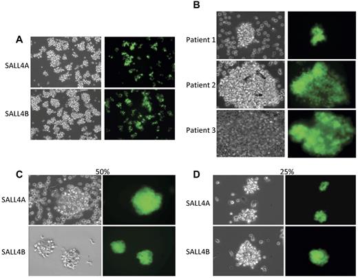 Figure 2. Expansion of SALL4-transduced HSCs. (A) HSCs transduced with SALL4A and SALL4B are able to survive and expand rapidly 7 days after lentiviral infection (10×). (B) CD34+ cells isolated from peripheral blood stem cells of 3 different patients. CD34+ cells were isolated from the stem cell pool using magnetic anti-CD34+ human microbeads. The CD34+-enriched cells were transduced with SALL4A and imaged under bright field and fluorescent microscopy (40×). All 3 samples from the various patients were successfully transduced with SALL4A and expanded rapidly in culture. In addition, SALL4-induced HSCs are able to expand when growth factor concentrations are decreased. When SALL4-transduced HSCs were cultured in growth media containing 50% less cytokines (C), they were still able to survive and expand 6 days after lentiviral infection (40×). Furthermore, when growth factor concentrations were decreased to 25% of original values (D), the SALL4-transduced HSCs continued to proliferate (40×). In contrast, control cells had undergone cell death by day 6.