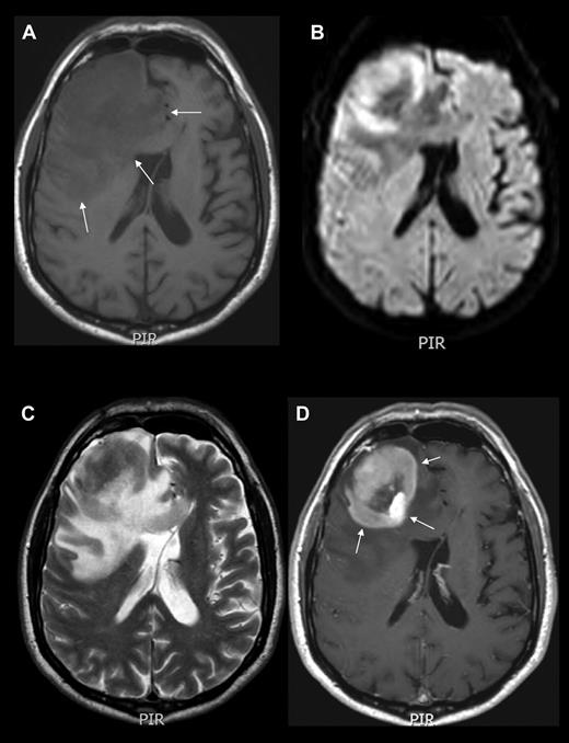 Figure 2. Neuroimaging example of PCNSL. MRI of the brain showing an expansive mass lesion in the right frontal lobe, which is hypointense in noncontrasted T1 scans (A), isointense with respect to cortex in T2-weighted images (C), with reduced average diffusion coefficient (B), and homogeneous contrast enhancement in contrasted T1 weighted scans (D arrows). Lesion is surrounded by modest edema (A arrows). CT and MRI findings are attributed to the high cell density and scant cytoplasm. Enhancement along the Virchow-Robin spaces, although not constant, is a highly specific feature of PCNSL.