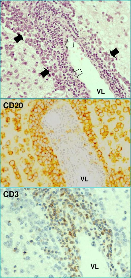 Figure 3. Classic histopathologic picture of PCNSL of diffuse large B-cell lymphoma category. Tumor cells (filled arrows) usually grow forming classic perivascular cuffings, are CD20 positive, and express other pan-B-cell markers (CD19, CD20, CD22, CD79a), markers of germinal center B cells (bcl-6; 60%-80% of cases), and markers of late germinal center B cells (MUM1; 90%), while are CD3 negative. A reactive T-cell infiltrate (open arrows) constituted by a perivascular rim of small lymphocytes interposed between vessel (VL) and neoplastic cells is observed in one-third of cases. These lymphocytes are smaller than neoplastic ones, and are CD20 negative and CD3 positive. The presence of this reactive infiltrate is associated with significantly better outcome in patients treated with modern approach.