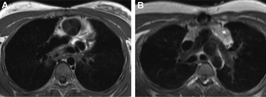 Figure 3. Visualization of thymic tissue in thymectomized individuals. (A) MRI of a patient (T25) 10.6 years after thymectomy showing no evidence of thymic tissue. (B) MRI of a patient (T30) 16.5 years after neonatal thymectomy showing thymic tissue (*).