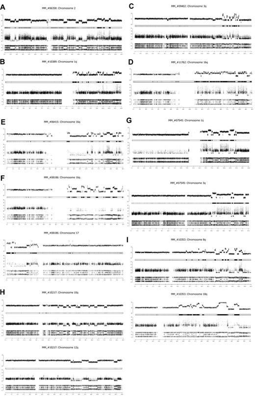Figure 1. Chromothripsis patterns in newly diagnosed MM patients. Assessment of DNA copy number changes by using genotyping SNP6 microarrays. (Top row) The total copy number (log scale), with the heat map below. (Middle row) The contribution of each allele to the copy number (minimum allele is in black and maximum allele in gray). (Bottom row) Allelic ratio for each SNP (homozygous SNPs cluster at ratios ∼ −1 and 1 and heterozygous SNPs ∼ 0). Genomic location (Mb) is indicated on the bottom. (A) MM_#06358 patient, copy number profile of chromosome 2. (B) MM_#10389 patient, copy number profile of chromosome 1q. (C) MM_#09402 patient, copy number profile of chromosome 3q. (D) MM_#11762 patient, copy number profile of chromosome 16q. (E) MM_#06415 patient, copy number profile of chromosome 16q. (F) MM_#08186 patient, copy number profile of chromosomes 16q and 17. (G) MM_#07545 patient, copy number profile of chromosomes 1q and 3q. (H) MM_#10217 patient, copy number profile of chromosomes 10p and 12q. (I) MM_#10353 patient, copy number profile of chromosomes 8q and 18q.