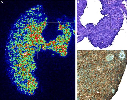 Figure 2. Quantitative α-camera autoradiography. The intratumoral distribution of 213Bi-DOTA-biotin after anti-CD45 PRIT was analyzed using a novel digital autoradiography bio-imaging system. This α-camera system is dedicated for the ex vivo detection of α-particles in tissue and uses a scintillation setup. The technique is quantitative and fully linear toward activity content in the imaged sections. At serial times after injection (10, 45, and 90 minutes), tumors were cryosectioned (thickness 12-16 μm). Three serial, immediately adjacent sections were obtained: (A) the first for α-imaging, (B) the second for H&E staining, and (C) the third for immunohistochemistry of blood vessels using CD34. This representative, digitally collected α-camera image was obtained 45 minutes after 213Bi-DOTA-biotin injection and was color-coded to express the different levels of activity concentration of 213Bi. Insets represent smaller sections of the image shown in the next panel (inset in panel A comprises entire picture in panel B; inset in panel B comprises entire picture in panel C).