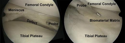 A case of chronic pain postsubtotal meniscectomy after a complex bucket handle tear of the meniscus in a soccer player. (Left) The probe indicates the large size meniscal defect. (Right) This is an arthroscopic view after meniscus transplantation with a cell-free biomaterial. The probe indicates the meniscal defect filling with the cell-free biomaterial. Vascular-forming matrices would improve the integration of the biomaterial and the in-growth of repair cells for regeneration of meniscus tissue.