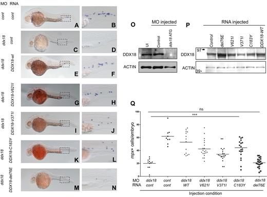 Figure 6. Assessment of developmental effects and myeloid cell numbers identifies DDX18-E76del a nonfunctional allele of DDX18 found in AML. (A-N) Lateral views, head to the left and dorsal upward. Boxed region shows area of corresponding close-up in the caudal hematopoietic tissue. In situ hybridization for mpx at 27 hpf in AB embryos injected with ddx18 morpholino (C-N) or control morpholino (A-B) along with control RNA (A-D) or DDX18 RNAs encoding WT (E-F) or sequence variant (G-N) proteins. Injection of DDX18 WT-, V621I-, V371-, or C183Y-encoding RNA was able to rescue the developmental and myeloid defects of ddx18 morphants (E-L compared with C and D). DDX18-E76del–encoding RNA was not able to rescue any of the ddx18 morphants (M-N) compared with panels C and D. (O) Western blot for Ddx18 showing the ddx18ATG/5′ UTR morpholino results in the loss of Ddx18 protein. (P) Western blot for DDX18 showing expression of sequence variant proteins. Control-injected embryos show expression because of cross-reactivity of the Ab with the zebrafish protein. (Q) Scatter plot showing number of mpx-expressing cells per embryo. ***P ≤ .0002. ns indicates not significant (Student t test).