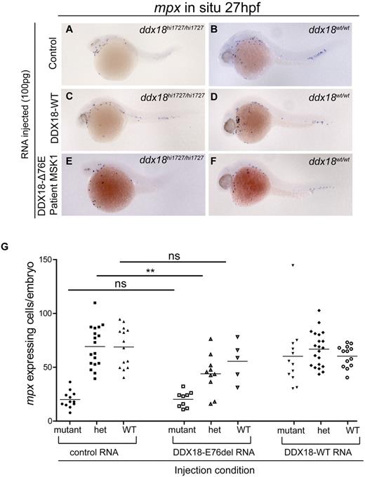 Figure 7. DDX18-E76del expression in ddx18hi1727/+ animals identifies a dominant-negative effect on myeloid cells. (A-F) Expression of control (mCherry encoding; A-B), DDX18-WT encoding (C-D), or DDX18-E76del (E-F) encoding RNA in ddx18hi1727/hi1727 mutant (A,C,E) or ddx18+/+ (B,D,F) embryos shows the DDX18-E76del variant cannot rescue the phenotype of ddx18hi1727/hi1727. Lateral views, head to the left, dorsal upward of 27-hpf embryos. (G) Quantitation of myeloid cell numbers from individual genotyped (imaged) embryos injected with control, DDX18-WT, and DDX18-E76del encoding mRNAs. Embryos injected with control or DDX18-WT encoding RNA show no difference in myeloid cell numbers between heterozygous ddx18hi1727/+ and ddx18+/+ siblings. Embryos injected with DDX18-E76del encoding mRNA, however, have a statistically significant reduction in myeloid cell numbers compared with control or DDX18-WT–injected ddx18hi1727/+ siblings. **P = .002 (unpaired Student t test).