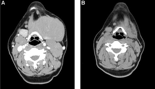 Figure 3. Early response in bulky, chemoresistant lymphoma. A 33-year-old woman with CLL/SLL had a partial response lasting 10 months after initial therapy with 6 cycles of fludarabine-R and then experienced progressive disease while receiving pentostatin-cyclophosphamide-R, and continued progressive disease while receiving CHOP. (A) Baseline image reveals a dominant 12 cm left submandibular mass. She was treated with 32 mCi of 90Y-ibritumomab tiuxetan, fludarabine, 2 Gy TBI, and a matched unrelated allogeneic transplant and achieved a PR by after transplantation day 28 (B) and complete remission by day 84. The patient remains alive and disease-free 3 years after transplantation.