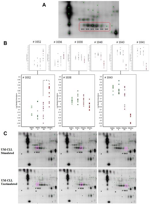 Figure 5. Example of 2D-DIGE analysis (using DeCyder software v6.5, GE Healthcare) of multiple isoforms of LSP1. (A) Focus of the 6 identified isoforms of LSP1 on 2D gel image. (B) Statistical analysis (3 UM-CLL vs 2M-CLL patient, #M3 patient excluded) of the 6 polypeptide spots identified as LSP1 with focus on 3 isoforms #1032, #1038, and #1043: #1032 acid isoform is significantly increased after anti-IgM stimulation in UM-CLL samples (*P < .0003), #1038 isoform presents no significant modification, and #1043 basic isoform is marginally decreased after anti-IgM stimulation. Such changes (increase of acid isoform and decrease of basic isoform) in 2D electrophoresis suggest a phosphorylation mechanism. (C) Focus of LSP1 isoforms on US/S UM-CLL samples 2D gel images (scanned using an Ethan DIGE Imager, GE Healthcare).