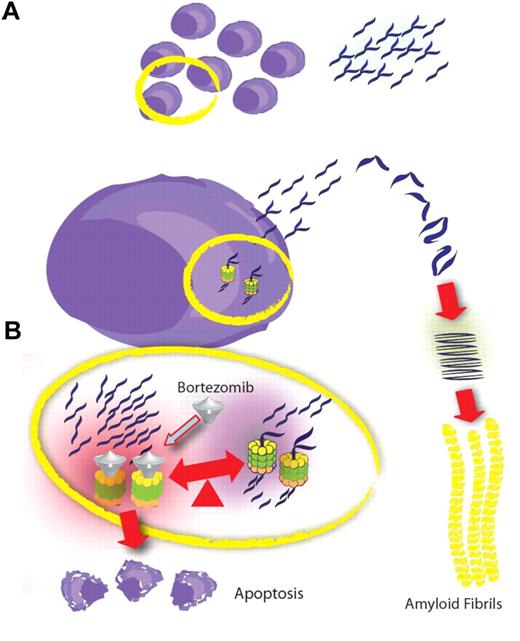 A small plasma cell clone produces poor quality amyloidogenic light chains that, mostly outside the plasma cell, tend to misfold and form amyloid fibrils (A). Inside the plasma cell the increased protein load induces ER stress and mechanisms to retain homeostasis require the rapid clearance of these proteins. The degradation of these poor quality proteins is largely dependent on proteasome activity. Bortezomib blocks proteasome degradation of proteins and increases poor quality protein load within ER thus inducing ER stress beyond the capacity of the control mechanisms and resulting in plasma cell apoptosis (B).