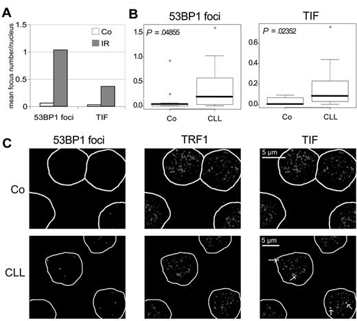 Figure 3. Telomeric damage induced foci in B cells from healthy donors and CLL patients. Confocal immunofluorescence analyses of 53BP1 foci and TRF1/53BP1 colocalization (TIF). (A) CLL B cells isolated from one CLL patient were subjected (IR) or no (Co) to 5 Gy γ-IR and fixed for immunostaining 1 hour latter. Median number of 53BP1 foci and TIF per nucleus is shown. (B-C) B cells from 11 healthy donors (Co) and 18 CLL patients (CLL) were immunostained for 53BP1 and TRF1; 53BP foci and TIF were scored after confocal analysis. (B) Box plot showing number of 53BP1 foci (left) and TIF (right) per nucleus; Wilcoxon-calculated P values are indicated in each box plot. (C) Immunofluorescence representing pictures of 53BP1 foci (left), TRF1 labeling (middle), and TIF (right) in B cells from healthy donor (top) and CLL patient (bottom). Arrows indicate TIF; TOTO staining is outlined in the equatorial plane of the nucleus. Detailed of ×60 magnification are shown after z-stack reconstruction (Image J software).