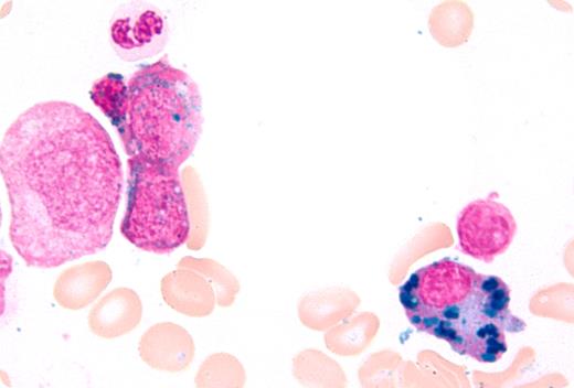 A 70-year-old man with multiple myeloma had been treated with chemotherapy and an autologous stem cell transplant. He had been in remission for 3 years. For 2 years, he had had persistent absolute neutropenia (< 1000/μL), anemia (hemoglobin < 85 g/L), and thrombocytopenia (platelets < 30 000/μL), requiring growth factors and red cell and platelet transfusions every 2-3 weeks. Bone marrow evaluation to investigate the cause for refractory cytopenia showed trilineage dyspoiesis consistent with development of therapy-related myelodysplasia; Prussian blue stain demonstrated increased iron stores, ringed sideroblasts (10%-15%), and plasma cells with hemosiderin iron (shown). Laboratory tests showed high serum iron and markedly increased ferritin. Serum levels of vitamin B12, folate, copper, and ceruloplasmin were within the normal range. The patient was prone to infections due to neutropenia and died from complications of bacterial sepsis. / Iron accumulation in plasma cells is rare, but it has been reported in individuals with alcoholism, myeloma and other malignancies, megaloblastic anemia, other causes of iron overload, including in patients with frequent transfusions, and in copper deficiency. The mechanism for iron accumulation in plasma cell cytoplasm (or cytoplasmic structures) is uncertain.
