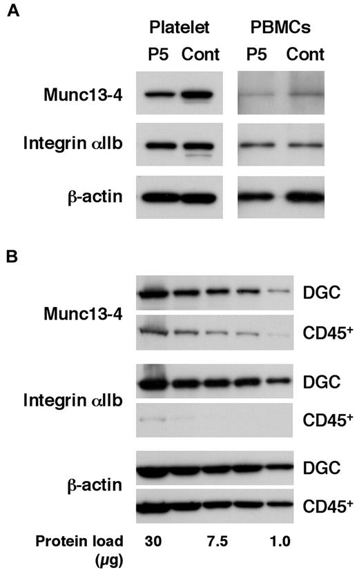 Figure 2. Effect of platelet transfusion on Western blot analysis. (A) Western blotting analysis for Munc13-4 expression using platelets and PBMCs from an FHL3 patient (P5) receiving platelet transfusions during the acute phase of the disease. (B) The expression of Munc13-4 was compared between PBMCs obtained by density gradient centrifugation (DGC) and CD45+ cells obtained by magnetic sorting from healthy controls. A representative result of 3 independent experiments is shown.