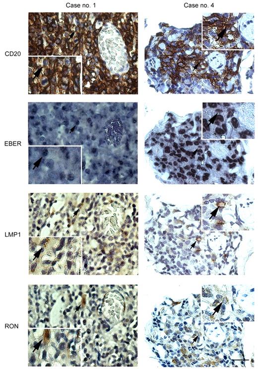 Figure 7. LMP1 and RON are coexpressed in EBER-positive B cells in 2 PTLD biopsies. Formalin-fixed, paraffin-embedded PTLD consecutive sections of case nos. 1 and 4 were stained for the expression of CD20, EBER, LMP1, and RON. Positive CD20 staining is seen as a dark brown precipitate on the surfaces of the B cells. The EBER signal was characterized by a dense purple. Positive immunoreactivity against LMP1 and RON was seen as a light brown color. Co-localization among EBER, CD20, LMP1, and RON was observed using a Zeiss photomicrographic system (Axioskop 40 FL) equipped with Image-Pro Plus software and indicated by arrow. Magnification ×400 (scale bar, 25 μm).