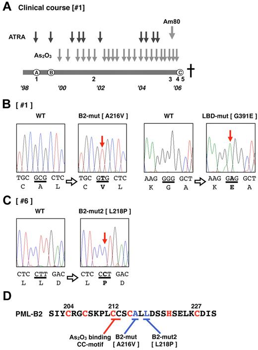 Figure 1. Additional genetic mutations in PML-RARA in patients showing an As2O3 refractory/resistant phenotype. (A) Clinical course of patient 1, who showed As2O3 resistance in the terminal stage of disease progression. The total clinical duration of the patient was almost 7 years. Detailed information is described in “Methods.” Black and gray arrows indicate the course of chemotherapies with ATRA, As2O3, and Am80. The letters A-C enclosed in circles indicate clinically important time points: A indicates diagnosis with APL, B indicates relapse with inadequate response to ATRA, and C indicates confirmation of clinical As2O3 resistance. This patient died of disease progression. Leukemia cells from the bone marrow and peripheral blood were obtained at time periods 1-5. Genetic mutations in PML-RARA were confirmed in patients 1 (B) and 6 (C). Missense point mutations in the PML B2 domain and RARA LBD domain were confirmed in the leukemia cells from time point 5. DNA sequences and the genetic code are indicated in capital letters. Bold letters indicate mutations. (D) The zinc finger motif of the PML-B2 domain. Amino acid substitutions in patients 1 and 6 are depicted. The CC motif critical for As2O3 binding25 is also indicated. The “C” and “H” in red are the cysteine and histidine, respectively, which are important for zinc finger formation.