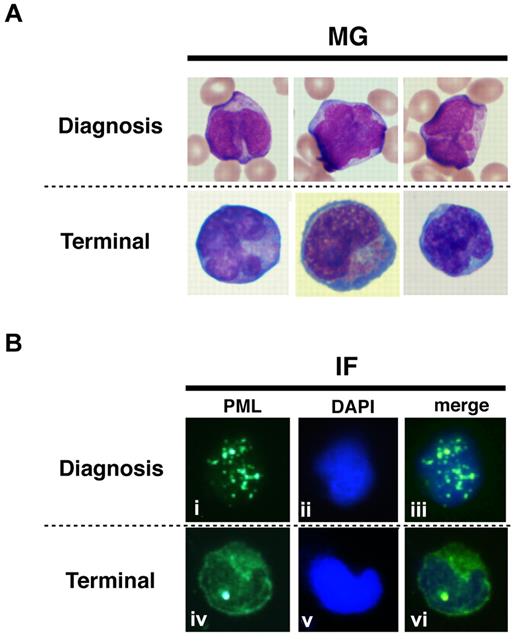 Figure 7. Protein localization of PML and its fusion proteins in primary leukemia cells from patient #1. May-Giemsa (MG) staining (A) and IF staining (B) are shown. The primary leukemia cells from patient 1 were obtained at diagnosis and at the terminal stage (shown as 1 and 5, respectively, in Figure 1A) and were used in this assay. PML nuclear bodies can be observed in the cells at diagnosis (i and iii), but at the terminal stage, PML and its fusion proteins were observed in the cytoplasm showing a diffuse pattern (iv and vi).