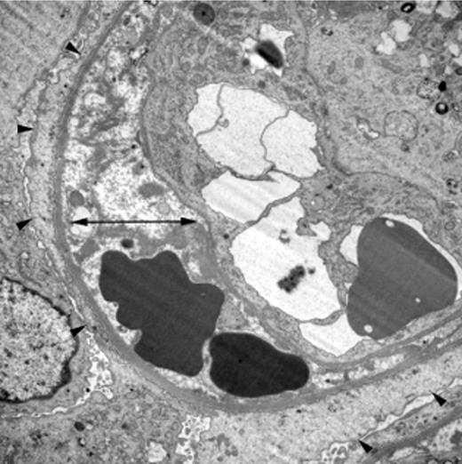 Figure 1. Characteristic renal histology in TA-TMA. Electron microscopy (×8000) from the kidney biopsy of a child who developed TA-TMA after autologous HSCT. It shows irregular electron-lucent expansion of the subendothelial zone (double arrow) and diffuse podocyte foot process fusion, a sign of damage to the glomerular filtration barrier (arrowheads). Reprinted by permission from Macmillan Publishers Ltd.13
