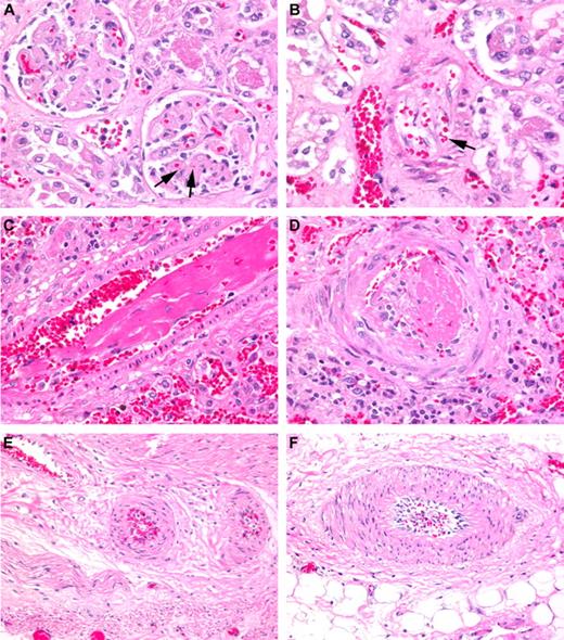 Figure 2. Histologic examples of TA-TMA affecting various organs. (A) Renal cortex with glomeruli showing thickened capillary walls and occluded vessel lumens. Red blood cell fragments can be seen (arrows) trapped in the mesangial matrix (H&E stain; magnification ×200). (B) Renal arteriole with separation of the endothelial cell layer from the arteriole wall with entrapped fragmented red blood cells (arrow). “Floating” endothelial cells (arrows) can be seen occluding the lumen of the vessel (H&E stain; magnification ×200). (C) Lung arteriole showing denuded endothelial layer with large fibrin thrombus trapping red blood cell fragments (H&E stain; magnification ×200). (D) Pulmonary arteriole with a recent thrombus and extravasated red blood cells (H&E stain; magnification ×200). (E-F) Mesenteric arterioles in the small bowel showing endothelial cell separation and red cell extravasation (H&E stain; magnification ×200). Nikon Eclipse 80i, 20×/0.75, Diagnostic Instruments 14.2 color mosaic, Spot software Version 4.6, Gimp 2.6.