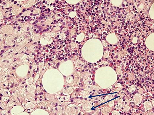 Figure 1. Acute myelogenous leukemia in a patient with otherwise asymptomatic GD. The Gaucher cells are indicated by arrows. Courtesy of Drs Ginette Shibi, Iris Barshack, and Hannah Maayan, Sheba Medical Center, Tel-Hashomer, Israel.