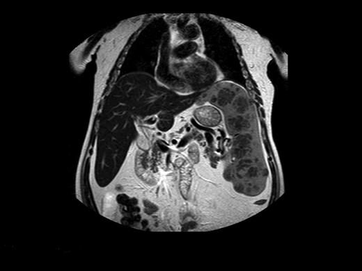 Figure 2. Magnetic resonance image of a 72-year-old man who did not respond to long-term high-dose ERT and improved after splenectomy. Courtesy of Dr George Blinder, Mar-Mor, Jerusalem, Israel.