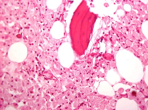 Figure 3. Histologic specimen from a femoral head removed during arthroplasty of a patient after 15 years of ERT. Courtesy of Dr Ehud Lebel, Shaare Zedek Medical Center, Jerusalem, Israel.