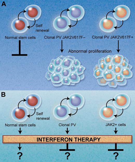 Effect of IFN on PV stem cells. (A) Simplified scheme of different stem cell compartments in polycythemia vera. Dormant normal stem cells do not contribute to productive hematopoiesis and coexist alongside clonal stem cells with and without JAK2V617F somatic mutation(s). (B) It remains to be determined whether interferon preferentially stimulates proliferation of dormant normal hematopoietic cells, clonal JAK2V617F−, or JAK2V617F+ subclone stem cells. Professional illustration by Alice Y. Chen.