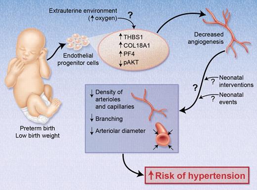 Proposed model of the mechanistic link between low birth weight (LBW) due to preterm birth and adult developmentally programmed hypertension. Ligi et al demonstrate that endothelial progenitors in the cord blood of LBW infants have increased expression levels of antiangiogenic molecules, including thrombospondin 1 (THBS1), endostatin (COL18A1), and platelet factor 4 (PF4), and decreased levels of phosphorylated AKT (pAKT). This angiostatic profile was associated with substantially decreased angiogenic properties, which—if persistent—could explain the vascular abnormalities found in former LBW infants with developmentally programmed hypertension in adulthood. It remains unclear whether and how the premature transition from the intrauterine to the extrauterine (oxygen-rich) environment affects the angiogenic properties of LBW endothelial progenitors, how long the angiogenic defects persist, and how events and interventions during early neonatal life influence this process. Professional illustration by Alice Y. Chen.