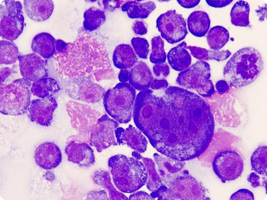 A 68-year-old man with a 10-year history of HIV, compliant with anti-retrovirals (ARV), presented with neck lymphadenopathy. A diagnosis of mixed cellularity Hodgkin lymphoma was made by biopsy. Staging investigations, including bone marrow aspirate/biopsy, cerebrospinal fluid examination, and PET/CT imaging confirmed stage IA disease. He was treated with 4 cycles of chemotherapy and involved field radiotherapy. Cumulative anthracycline doses previously administered for Kaposi sarcoma obviated the usual chemotherapy program; therefore, chlorambucil, vinblastine, procarbazine, and prednisolone were employed. A complete remission was confirmed with PET/CT. / Six months later, he developed progressive dizziness, dysarthria, and fatigue. CT brain, PET/CT body, MR brain, and spinal cord examinations identified no cause. Viral load remained undetectable and CD4 count was 65 (8%), suggesting limited immunologic recovery despite ARV compliance. An exhaustive search for an infectious cause was negative. Cerebrospinal fluid analysis demonstrated a leukocytosis (100/mm3) and an elevated protein (357 mg/dL) with Reed Sternberg cells present (shown), consistent with central nervous system relapse (CNS-HL). Despite intrathecal chemotherapy, whole brain radiotherapy, and subsequent systemic chemotherapy, he died. There was no autopsy. / CNS-HL is unusual. Leptomeningeal spread has been reported more commonly in patients with widespread relapsed disease or in immunocompromised patients.