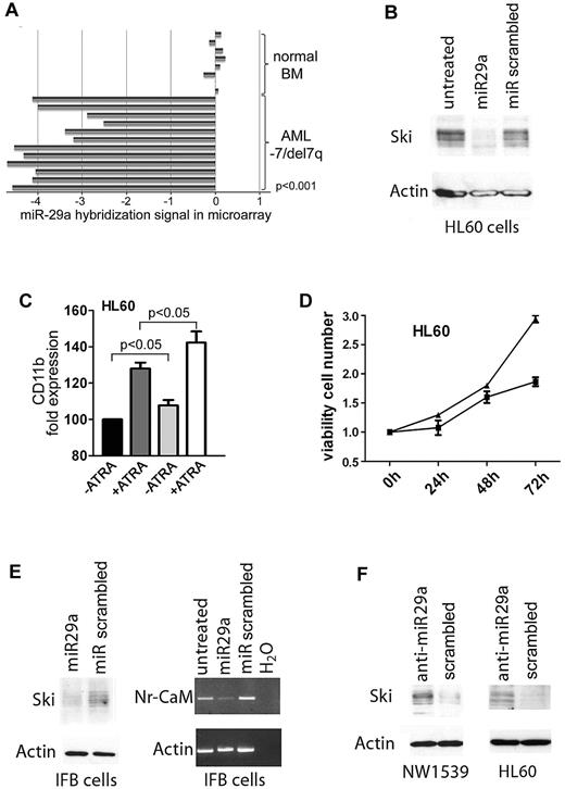 Figure 1. Expression of miR-29a is down-regulated in AML with −7/del7q and regulates expression of Ski. (A) Expression of miR-29a in AML patient samples with isolated −7/del7q karyotype or complex karyotype including −7/del7q. Expression levels of miR-29a in 12 AML samples with −7/del7q as determined by microarray analysis compared with miR-29a expression in 8 samples of normal bone marrow. Five of the original 17 values for miR-29a expression in AML samples are missing. (B) miR-29a inhibits Ski expression. HL60 cells were transfected with 29a or scrambled precursor miRNA. After 24 hours, Ski expression was analyzed in whole-cell protein extracts with Western blot. Loading control was β-actin. (C) miR-29a enhances ATRA-induced differentiation of myeloid HL60 cells. Cellular differentiation of HL60 cells transfected with 29a or scrambled control precursor miRNA additionally treated with 1.5μM ATRA for 72 hours was analyzed with flow cytometry. Black bar indicates miR-scrambled; dark gray bar, miR-scrambled plus ATRA; gray bar, miR-29a; white bar, miR-29a plus ATRA. CD11b expression of miR-scrambled transfected cells was set at 100%. Results are representative of 3 independent experiments. Values shown are mean ± SEM. (D) miR-29a reduces proliferation of myeloid HL60 cells. HL60 cells were transfected with miRNA precursor 29a or scrambled control. After 0, 24, 48, and 72 hours, proliferation was tested in an MTT assay. ■ indicates miR-29a; ▴, miR scrambled. Experiment was performed 3 times in triplicate. Values shown are mean ± SEM. (E) Expression of the Ski target gene Nr-CAM is inhibited by miR-29a. IFB melanoma cells were transfected with miR-29a or scrambled precursor miRNA. After 24 hours, Ski expression was tested in whole-cell protein lysates by Western blot (left). Loading control was β-actin. Nr-CAM expression was measured by PCR (right). Control was β-actin. (F) Inhibition of miR-29a induces Ski expression. NW1539 melanoma cells (left) or HL60 cells (right) were transfected with anti–miR-29a or scrambled oligonucleotide. After 48 hours, Western blot was performed for Ski with whole-cell protein extracts. Loading control was β-actin.