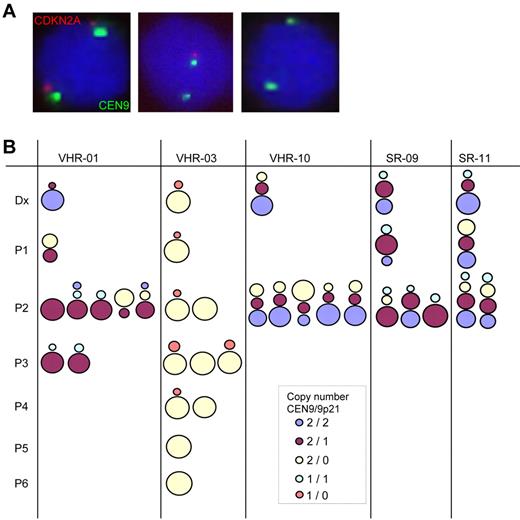 Figure 5. Interphase FISH analysis of 9p21 (CDKN2A) lesions reveals the existence of genetically distinct subclones. The clonal composition of ALL samples was analyzed using dual-color FISH probes against 9p21 (CDKN2A, red) and the centromer of chromosome 9 (CEN9, green) as control in samples from diagnosis and corresponding xenografts. (A) Representative images are shown, indicating wild-type cells with no deletion in the 9p21 locus (left), a heterozygous deletion (middle), and a homozygous deletion (right). (B) The clonal distribution was analyzed in samples from up to 6 rounds of serial transplantation. A total of 200 cells were counted in each sample. The original data are reported in supplemental Table 7. ALL cells with germline, heterozygous deletion, and homozygous deletions are represented by colored dots of size proportional to the percentage of cells in each category in relation to the total cell number as indicated in the legend. One case, VHR-01, shows clonal selection toward additional deletions at this locus, whereas the 4 other cases analyzed are more stable with respect to the clonal composition based on this genetic feature. Original magnifications ×40 (Leica LX Widefield Microscope DMI6000B with the DFC 350 FX R2 camera).