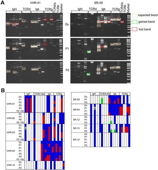 Figure 6. Analysis of Ig/TCR rearrangements reflects the evolution of the clonal compartment in xenografts. The Ig/TCR rearrangement pattern of diagnostic samples and matched xenografts was determined in 5 VHR- and in 5 SR-ALL samples by PCR using standardized sets of primers that are validated for MRD analysis. (A) Representative examples for a VHR-ALL (left panel) and an SR-ALL (right panel) sample, which showed a marked acceleration from primary to secondary passage. All positive bands of the correct size were sequenced once for verification. Stable rearrangements are framed with an orange line; and bands framed in red represent markers that disappeared in xenografts. In this SR sample, one new Ig/TCR rearrangement appeared (framed in green). (B) Overview of Ig/TCR rearrangements detected. Detected Ig/TCR rearrangements are highlighted in blue. Loss of such a marker in a given xenograft is highlighted in red. Newly detected markers in xenografts are highlighted in green.