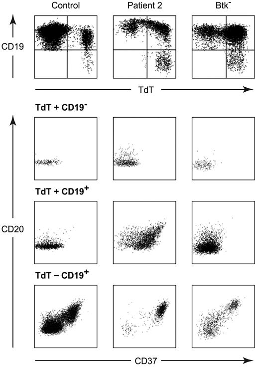 Figure 5. Expression of differentiation markers on BM-derived B-lineage cells from a healthy child, patient 2, and a patient with a mutation in Btk (W588X). Cells were stained with APC CD19, PE CD37, and APC-Cy7a CD20, then permeabilized and stained with FITC TdT. The top panel shows all cells that were positive for either CD19 or TdT with gates drawn to identify TdT+/CD19−, TdT+/CD19+, and TdT−/CD19+ populations. The expression of CD20 and CD37 on each of these populations is shown in the bottom panel.