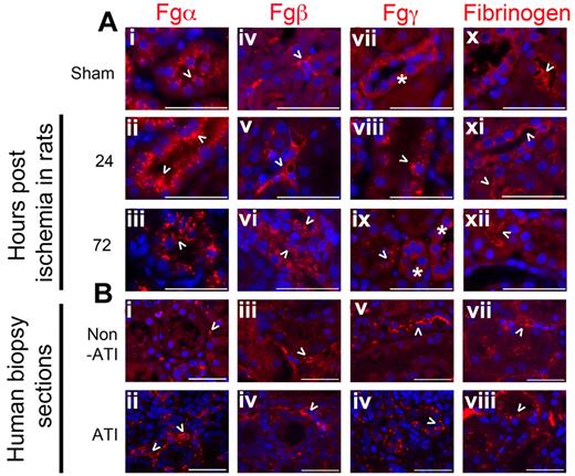Figure 2. Fg (immunoreactive Fgα, Fgβ, and Fgγ chains) protein is expressed in the kidney of rats and humans. (A) Representative formalin-fixed paraffin-embedded kidney tissue sections of sham male Wistar rats and those from rats that had undergone 20 minutes of bilateral ischemia reperfusion stained for immunoreactive proteins to Fgα (i-iii), Fgβ (iv-vi), Fgγ (vii-ix), and Fg (x-xii) after 24 and 72 hours of reperfusion and compared with healthy (sham) kidneys. Bar represents 50μm. (B) Representative formalin-fixed human-biopsied kidney sections of AKI and non-AKI patients, stained for immunoreactive molecules recognizing Fgα (i-ii), Fgβ (iii-iv), Fgγ (v-vi), and Fg (vii-viii). Bar represents 50 μm. Arrowheads indicate respective immunoreactive molecules. Asterisks in panels Bvii and Bix mark tubules with similar expression pattern along the basolateral side of respective tubules.