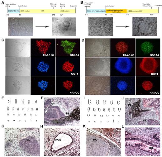 Figure 1. Reprogramming of EBV-B cells into iPSCs. (A-B) Diagram of the reprogramming process of AAT-deficient patient fibroblasts (A) and EBV-transformed B-cell lines (B). Bright-field images of parental cells before reprogramming and typical colonies right before colony picking are shown. (C-D) Immunofluorescence analysis of pluripotency markers for fibroblast-derived iPSCs (C, iAF3 is shown) and EBV-B cell–derived iPSCs (D, iAB5 is shown). Expression of PSC surface antigens TRA-1-60 and SSEA4 and transcription factors OCT4 and NANOG are observed (magnification, ×200). (E,I) Karyotype analyses for iAF3 and iAB5 lines, respectively. (F-H, J-L) Hematoxylin and eosin staining of teratomas derived from immunodeficient mice injected with either iAF3 (F-H) or iAB5 (J-L) show tissues representing all 3 germ layers (magnification, ×200). Ectoderm (F,J): PE indicates pigmented epithelium; NR, neural rosettes. Mesoderm (G,K): MC indicates mature cartilage; IC, immature cartilage. Endoderm (H,L): RGE indicates respiratory glandular epithelium; IGE, intestinal glandular epithelium.