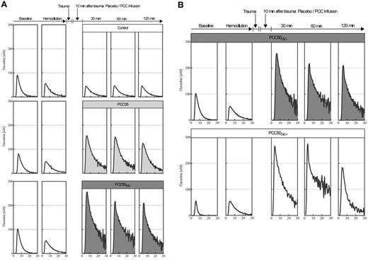 Figure 4. Representative curves from the thrombin generation assays. (A) Plasma thrombin generation, for assessment of hypercoagulability after PCC administration. Thrombin generation in platelet-poor plasma was assessed by means of the CAT according to standard in-house procedures, using 1pM tissue factor and 4μM phospholipids to trigger the assay. Representative curves are shown for baseline, hemodilution, and 30, 60, and 120 minutes after trauma, following the administration of saline (top row: open curves); 35 IU/kg PCC (middle row: light gray curves); and 50 IU/kg PCC (bottom row: dark gray curves). Independent of the dose of PCC, plasma thrombin generation was characterized by a prolonged time to tail, indicating attenuated inhibition of coagulation. (B) 50 IU/kg PCC can induce a hypercoagulable state associated with DIC. Top row: thrombin generation curves in plasma from an animal receiving 50 IU/kg PCC and not developing DIC. Bottom row: thrombin generation curves in plasma from an animal receiving 50 IU/kg PCC and developing DIC (PCC50DIC+). Remarkably, no difference was observed in thrombin generation before and after hemodilution.