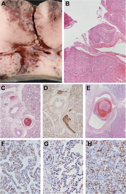 Figure 6. Macroscopic liver injury and microscopic histology of lung tissue: representative samples. Postmortem internal organs were removed to evaluate the degree of liver injury and to assess the occurrence of any thromboembolic events. (A-B) Macroscopic and histologic images of liver trauma, with laceration of venous vessels up to 4 mm in diameter. (B) H&E stain. (C-E) Multiple thromboemboli in the PCC50 group (up to 4 mm in panel E). (C,E) H&E stain. (D) Immunohistochemical staining against fibrinogen. (F-G) Samples from the control group and PCC50 without DIC with rare, irregular, small deposits of fibrinogen in lung capillaries. (H) Net-like staining pattern for fibrinogen in lung capillaries of animals of the PCC50 group wth DIC. (F-H) Immunohistochemical stain against fibrinogen. Original magnification: panels B and E, 20×; panels C-D, 40×; panels F-H, 400×.