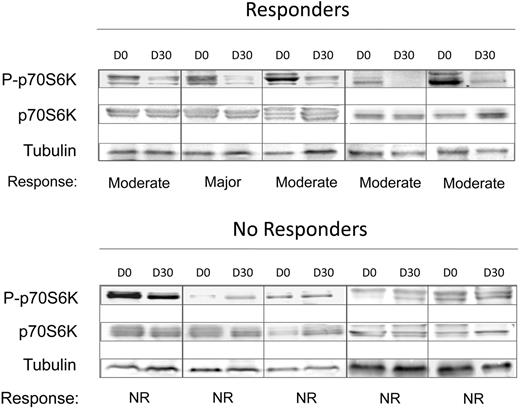 Figure 2. The phosphorylation status of the mTOR target, p70S6K, measured at 1 month of treatment, correlates with obtainment of clinical response. Proteins extracted from peripheral blood cells, collected at baseline (D0) and at 1 month of treatment (D30), were subjected to SDS-PAGE electrophoresis and Western blotting and probed with antibodies against the total and phosphorylated form of p70S6K; tubulin was used for loading normalization. Top, 5 patients who showed a major-to-moderate clinical response; bottom, 5 patients who were defined as nonresponders.