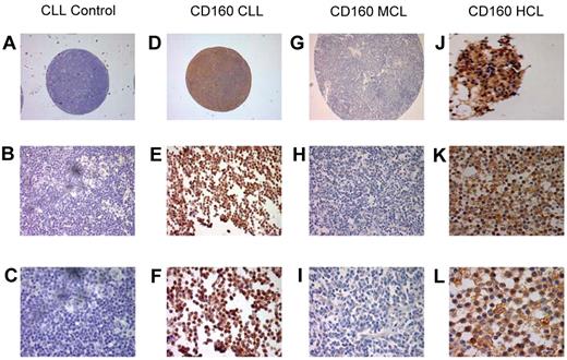 Figure 4. Immunohistological staining of CD160 in chronic B-cell malignancies. Tissue sections and TMAs were stained with CD160 antibody (10 μg/mL), incubated overnight at 4°C, and revealed using the Super Sensitive Polymer-HRP Detection System (Biogenex). (A-C) Control: a lymph node TMA spot from a patient with CLL without the primary antibody. Magnifications were ×5 (A), ×20 (B), and ×63 (C). (D-F) Positive CD160 staining of a CLL lymph node TMA. Magnifications were ×5 (A), ×20 (B), and ×63 (C). Of the CLL TMA cases, 85 of 88 (96.5%) were CD160+. (G-I) Negative CD160 staining of an MCL lymph node on a TMA. Magnifications were ×5 (A), ×20 (B), and ×63 (C). Of the MCL TMA cases, 94 of 97 were CD160−. (J-L) Two HCL cases showing typical strong CD160 positivity, a BM trephine (J), and a splenic biopsy. Magnifications were ×43 (K) and ×63 (L).