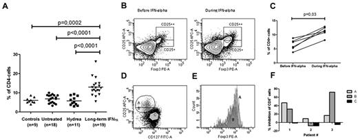 Figure 1. Frequency of CD25+Foxp3+ cells in the CD4+ T cell population in patients with chronic myeloproliferative neoplasms. (A) Frequencies of CD25+Foxp3+CD4+ T cells in patients with chronic myeloproliferative neoplasms who were untreated (4 ET, 11 PV, and 3 PMF patients), treated with hydroxyurea (Hydrea; 1 ET and 10 PV patients), or treated with IFN-α (8 ET, 10 PV, and 1 PMF patient) compared with healthy donors. In the IFN-α–treated group, 12 patients were in complete hematologic remission, 5 had a partial hematologic response, and 1 patient did not respond to therapy. No patients were in major molecular remission. The gating strategy is shown in panel B, and frequencies are reported as number of cells in gate CD25++ and CD25+ as percentage of CD4+ T cells. (B) Flow cytometric analysis showing the frequency of CD4+CD25+Foxp3+ cells in a 63-year-old woman with PV before and after 12 months of IFN-α treatment. The plot shows CD4+ cells previously gated on CD3+ cells in the lymphoid compartment. Gates represent CD25highFoxp3+cells and CD25intermediateFoxp3+ cells, respectively. Both Foxp3+ cells with CD25high and CD25intermediate expression expanded significantly during IFN-α2a treatment. (C) The frequency of CD4+CD25+Foxp3+ cells before and after 12-14 months of treatment with IFN-α2a in 6 JAK2-positive CMPN patients (4 ET and 2 PV). (D-E) Gating strategy for single cell sorting. Fraction A: CD4+CD25highCD127−; fraction B: CD4+CD25intermediateCD127−; Fraction C: CD4+CD25−CD127+. The histogram shows that > 90% of cells in fractions A and B expressed Foxp3; however, Foxp3 expression was discretely higher in fraction A. (F) Diagram showing inhibition of proliferating CD8+ T cells in the different fractions in 3 patients undergoing IFN-α2 treatment. Results are given as percentage inhibition of CD8+ T cells compared with positive controls. The suppressor/responder ratio was 1:3 in patient 2 and 1:2 in patients 1 and 3. In patient 1, more inhibitory activity was observed in fraction A than in fraction B. In patient 2, the inhibitory activity was very strong in fraction B compared with fraction A. Patient 3 had no or minimal suppression, and in fact, a discrete increase in proliferation was observed in fraction B.