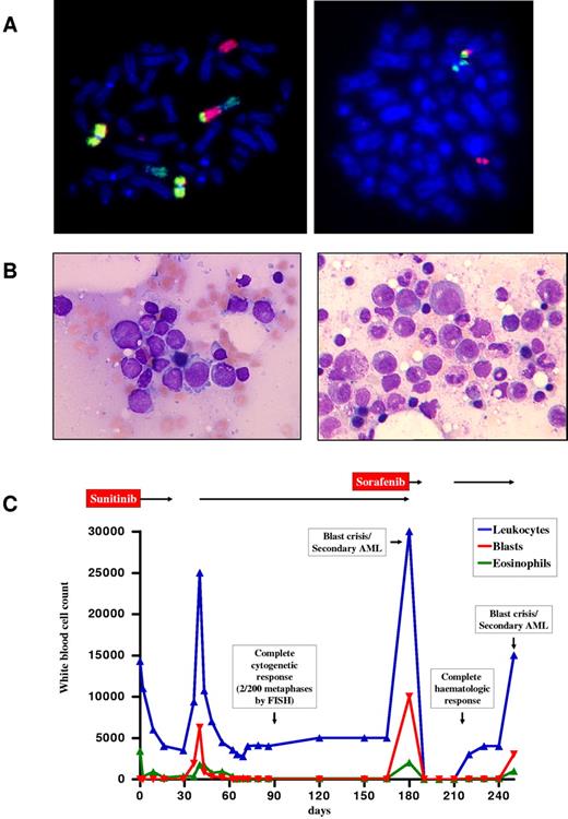Figure 1. Diagnosis and clinical course of patient 1. (A) FISH with whole-chromosome painting probes for chromosomes 9 (yellow), 12 (green), and 13 (red) demonstrating the 12;13 translocation and involvement of the derivative chromosome 12 in an additional translocation with chromosome 9 (left). FISH analysis confirmed involvement of ETV6, showing the 5′-ETV6 probe labeled in red on the derivative chromosome 13 and the 3′-ETV6 probe labeled in green on the derivative chromosome 12 in patient 1 at diagnosis (right). Cytogenetic and FISH analyses with break-apart probes for the detection of ETV6 rearrangements (Abbott) were performed according to standard procedures.14,15 (B) Bone marrow morphology of patient 1 at diagnosis of sunitinib-resistant blast phase/secondary acute myeloid leukemia 6 months after start of sunitinib (left) and 5 weeks after initiation of sorafenib (right). Micrographs were taken by an Axiolmager M1 (Zeiss) using an EC Plan-Neofluar, 100×/1.3 oil, 0.17 objective lens (Zeiss). (C) Hematologic response to treatment with sunitinib and sorafenib in patient 1 over a 250-day period. AML indicates acute myeloid leukemia.