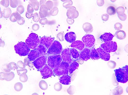 A 68-year-old woman developed progressive back pain and weight loss over a 3-month period. She was found to have a 5 × 6-cm2 firm, fixed mass in the left posterior neck. She had multiple comorbidities including an extensive 50 pack-per-year smoking history, coronary artery disease, type 2 diabetes, hypertension, and hypothyroidism. / Complete blood counts showed a mild pancytopenia with occasional teardrop cells on the peripheral blood film. Lymph node biopsy revealed extensive infiltration by a high-grade neuroendocrine carcinoma of unknown primary. Bone marrow examination revealed nests of medium to large nonhematopoietic monomorphic cells (one cluster shown) that were identical to those present in the lymph node biopsy. Unfortunately, while being evaluated, she rapidly deteriorated with a decreased level of consciousness and died 3 days later. An autopsy was not performed. / Pancytopenia and peripheral blood morphologic abnormalities were clues to the presence of metastatic disease infiltrating the bone marrow. Although the site of origin of clusters of nonhematopoietic cells within the marrow can be challenging, the malignant disease present in another tissue usually identifies them.