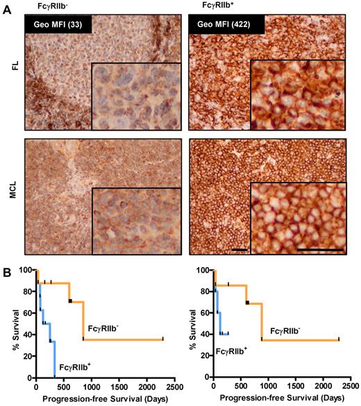 Figure 6. FcγRIIb levels predict progression-free survival in MCL patients treated with rituximab regimens. (A) Immunohistochemistry for FcγRIIb in FL (top panel, flow cytometric quantification of FcγRIIb expression of corresponding viable cells shown and MCL bottom panel) samples. Representative examples of negative (left) and positive membranous (right) staining are shown. The top left panel demonstrates FcγRIIb staining in the normal mantle region, which serves as an internal positive control for the staining. (B) Progression-free survival of 16 MCL patients treated with rituximab-containing regimens classified on the basis of positive or negative FcγRIIb expression by immunohistochemistry (left, n = 8 per group, P < .05, log-rank test), and 12 MCL patients treated with frontline FCR or rituximab alone (right, n = 6 per group, P value not significant, log-rank test).