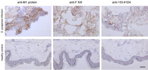 Figure 5. Immunohistochemical analysis of human biopsies. Tissue biopsies were obtained from patients with necrotizing fasciitis caused by S pyogenes (top) and from healthy volunteers (bottom). The biopsies were sectioned and immunohistochemically stained for streptococcal M1 protein, fXIII, and N-ϵ-γ-glutamyl-lysine. Stainings without primary antibodies were negative (data not shown). The scale bars indicate 50 μm.