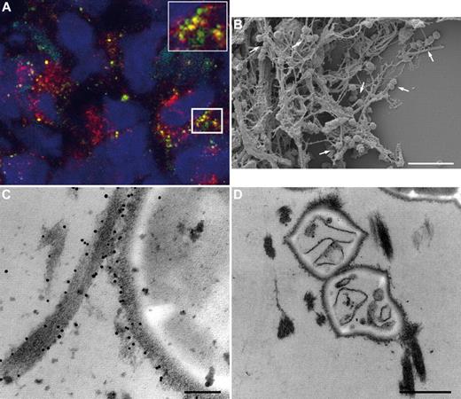 Figure 6. Colocalization of M1 protein and the fXIII cross-linking site in human biopsies. (A) Tissue biopsies from patients with streptococcal necrotizing fasciitis were sectioned and immunofluorescently stained for M1 protein (green) in combination with anti–N-ϵ-γ-glutamyl-lysine (red). Confocal microscopy revealed colocalization of both antibodies, seen at higher magnification in the inset figure. Cell nuclei are stained in blue with DAPI. (B) Scanning electron microscopy showing bacteria entrapped in the fibrin network (arrows) in a biopsy from a patient with streptococcal necrotizing fasciitis. Scale bar indicates 5 μm. (C) Transmission electron micrograph displaying fXIII-mediated cross-linking of bacterial surface proteins to fibrin by detection of the gold-labeled antibody against N-ϵ-γ-glutamyl-lysine. The scale bar indicates 100 nm. (D) Transmission electron microscopy shows dead bacteria inside the fibrin network in a biopsy from a patient with streptococcal necrotizing fasciitis. The scale bar indicates 0.5 μm.