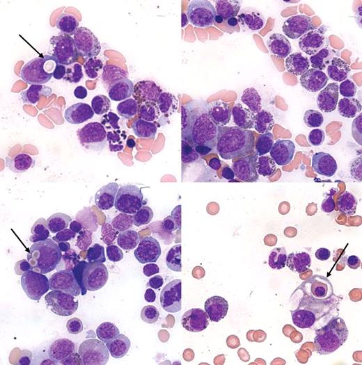An 18-month-old girl with a diagnosis of Chediak-Higashi syndrome (CHS) presented with severe bacterial skin infection. Recurrent episodes of bacterial infections began at the age of 2 months. On physical examination, generalized lymphadenopathy, hepatosplenomegaly, skin hypopigmentation, and silvery hair were noted. Bone marrow aspirate revealed prominent granules (top left and right) within the lymphocytes and myeloid cells. Phagocytosis of red cells and red-cell precursors (arrows) is also seen. A diagnosis of “accelerated phase” of CHS was made. She underwent an unrelated allogeneic hematopoietic stem cell transplantation. Three years later she is well and attending school. / Chediak-Higashi syndrome is a rare childhood autosomal recessive disorder of defective phagolysosome dysfunction. The gene CHS/LYST1 on chromosome 1q42-43 codes for CHS/LYST1 protein that is associated with microtubules and regulates lysosome-related organelle size and movement. Most patients eventually enter the accelerated phase shortly after birth or within several years. Epstein-Barr virus infections may contribute to the lymphohistiocytic proliferation that is noted. Once the accelerated phase occurs, it is usually fatal within a few months. This child is one of the survivors.
