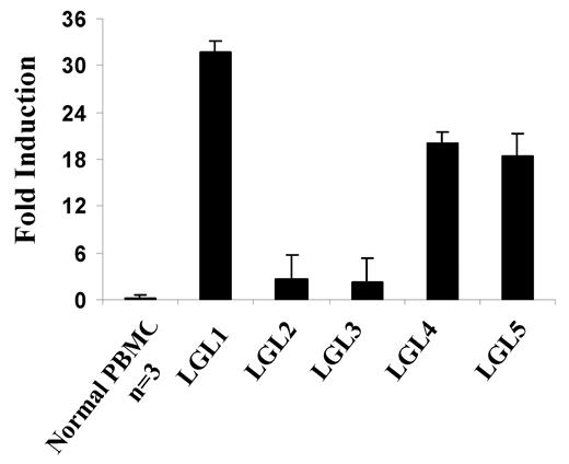 Figure 4. Increased expression of IFN-γ message in patients with T-LGL leukemia. TaqMan real-time RT-PCR analysis of IFN-γ mRNA levels in the PBMCs from T-LGL leukemia patients. The copy numbers of IFN-γ mRNA were normalized to the copy numbers of HPRT1 mRNA. The fold induction was calculated based on the normalized IFN-γ mRNA copy number in PBMCs from normal donors (n = 3).