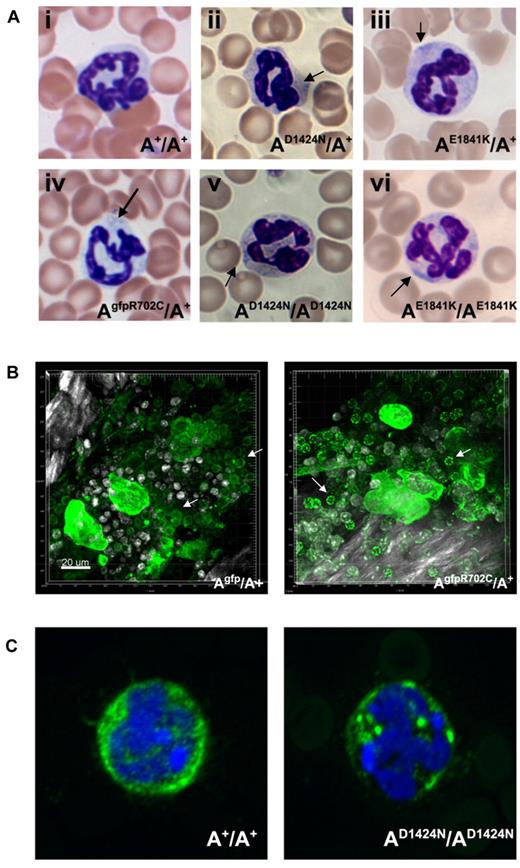 Figure 6. Neutrophil inclusion bodies in NMII-A mutant mice. (A) Representative images show inclusion bodies (arrows) that were found in neutrophils from mutant (Aii-vi) but not control (Ai) mouse blood smears. Blood smears are stained with Wright-Giemsa. (B) Live cell imaging of neutrophils (arrows) from Agfp/A+ and AgfpR702C/A+ mouse BM. The NMII-A in AgfpR702C/A+ neutrophils is more heterogeneous and punctate compared with NMII-A in the Agfp/A+ control. Green indicates GFP signal; white signal, bone collagen SHG; and white spots, Hoechst-stained nuclei. Bar, 20 μm. (C) Immunofluorescence confocal images of fixed neutrophils from A+/A+ and AD1424N/AD1424N mice. NMHCII-A (green) is distributed in the cytoplasm of the A+/A+ neutrophil. Mutant NMHCII-A D1424N aggregates into circular to oval-shaped cytoplasmic spots in AD1424N/AD1424N neutrophil. DAPI (blue) stains nuclei.