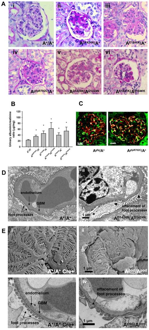 Figure 7. Kidney phenotype of NMII-A mutant mice. (A) Representative glomeruli from mutant mice show various stages of glomerulosclerosis in both heterozygous and homozygous glomeruli from segmental (Avi) to more nearly global (Aii-v). PAS-stained sections. Ages and sexes are (Ai) 9-month and female, (Aii) 6-month female, (Aiii) 12-month female, (Aiv) 12-month male, (Av) 9-month female, and (Avi) 7-month male. (B) Bar graph showing albumin/creatinine ratios in urine from mutant and A+/A+ mice. All the mutant mouse lines show increased albumin excretion (13 of 44 for AR702C/A+, 11 of 28 for the AD1424N/A+, and 4 of 11 for the AE1841K/A+) compared with A+/A+ mice. *P = .044, 1-way ANOVA, mean ± SEM. (C) Immunofluorescence confocal images of Agfp/A+ and AgfpR702C/A+ kidney glomeruli stained with anti-GFP (green) and anti-synaptopodin (red) showing localization of NMII-A in the podocytes. DAPI (blue) stains nuclei. Bar, 20 μm. (D) Transmission EM showing podocyte foot process effacement (arrow) in AD1424N/AD1424N glomerulus compared with A+/A+ foot processes. Scanning (Ei-ii) and transmission (Eiii-iv) EM images of A+/A+ cre+ and Apod/Apod glomeruli. The Apod/Apod podocytes are notable for shortened primary and secondary processes and reduced numbers of foot processes and filtration slits between the foot processes. Foot process widths (arbitrary units) were measured from the transmission EM obtained from 1 mouse of each genotype with the use of ImageJ (NIH): A+/A+ cre+: 0.105 ± 0.06, n = 371; and Apod/Apod: 0.319 ± 0.35, n = 293. GBM indicates glomerular basement membrane.
