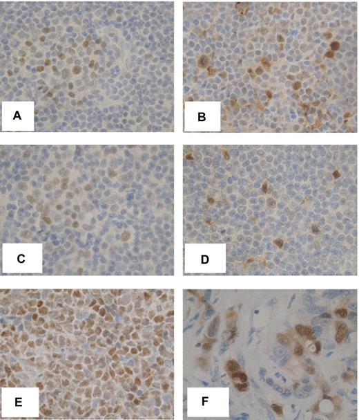 Figure 7. Expression of phosphorylated ERK1/2 and MYC in vivo. Immunohistochemical analysis of MYC (A,C) and phospho-ERK1/2 (B,D) in 2 CLL/SLL lymph node biopsy samples. The images show expression within representative PCs comprising larger, less densely stained cells. (E-F) MYC expression in Burkitt lymphoma and phospho-ERK1/2 expression in colon cancer, respectively. Original magnification ×600.